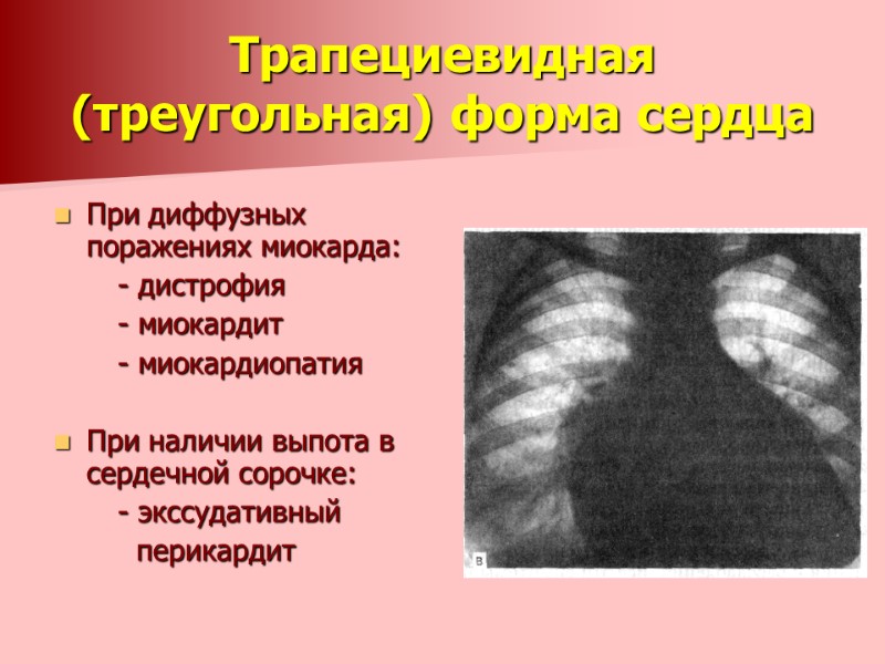 Трапециевидная (треугольная) форма сердца  При диффузных поражениях миокарда:     